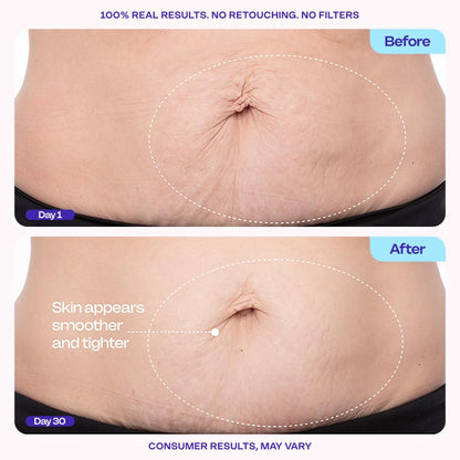 Tighten and Smooth Your Belly Skin With Target Firming Technology