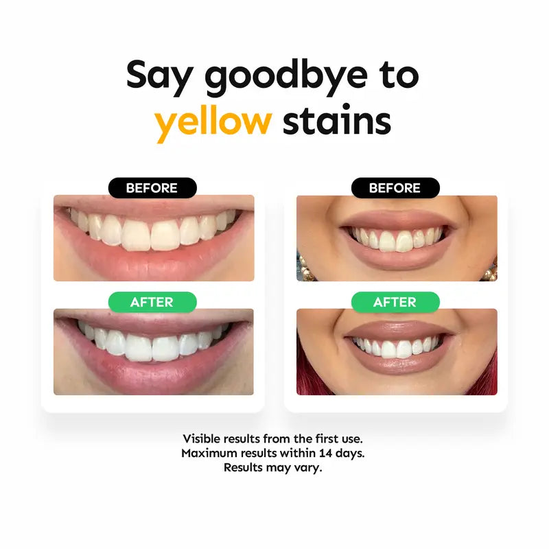 Whiter Smile, Zero Sensitivity — The Professional Non-Peroxide Whitening Secret - 56 strip pro