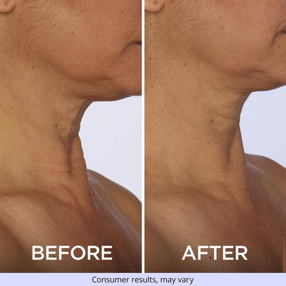 Tighten and Smooth Your Belly Skin With Target Firming Technology
