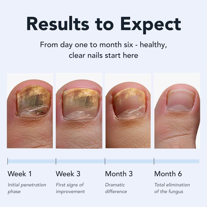Eliminate Fungal Infections with Maximum Strength 25% Undecylenic Acid