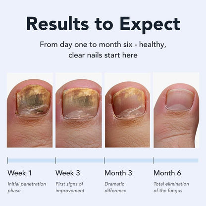Eliminate Fungal Infections with Maximum Strength 25% Undecylenic Acid