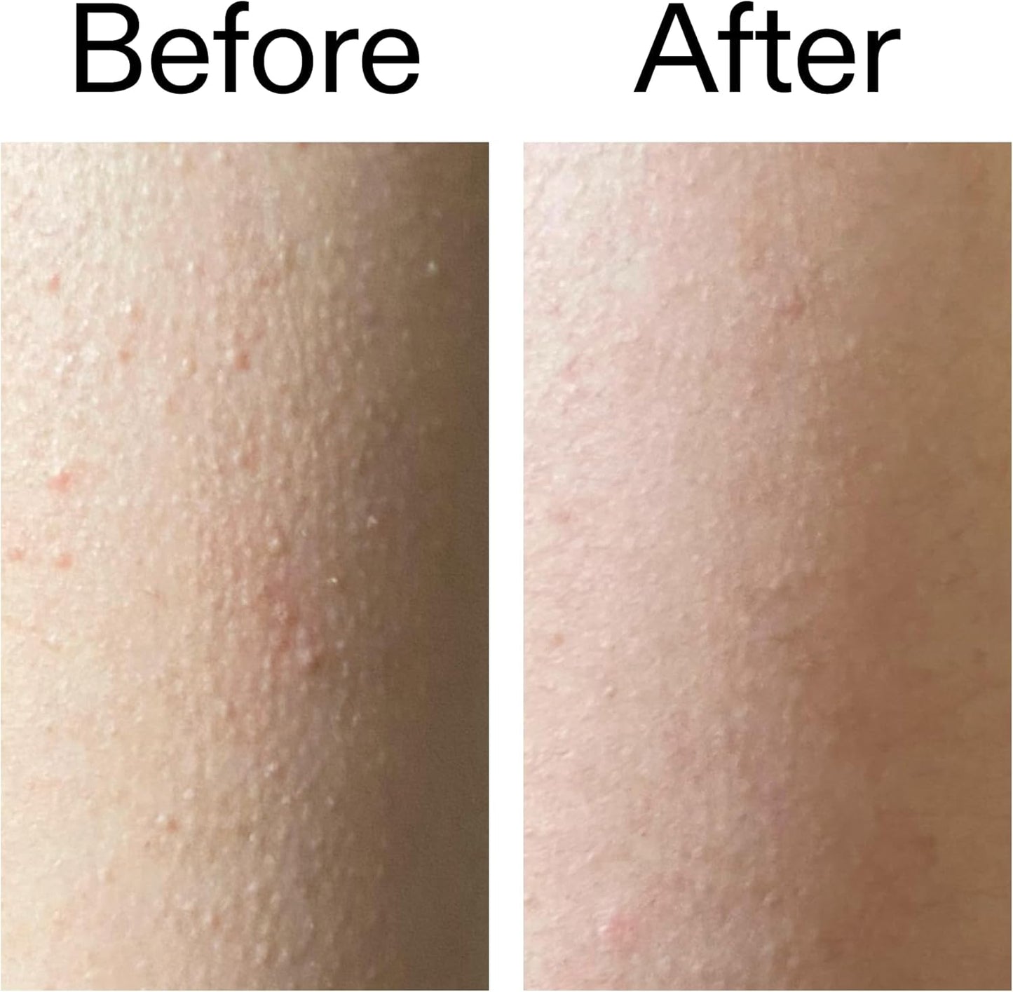 Say Goodbye to Bumpy "Strawberry Skin" in Just 7 Days