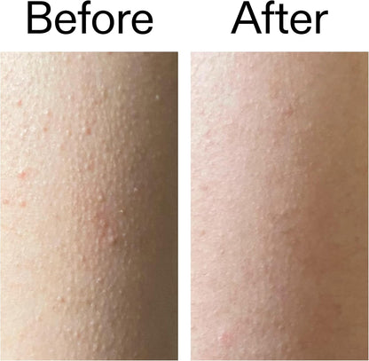 Say Goodbye to Bumpy "Strawberry Skin" in Just 7 Days