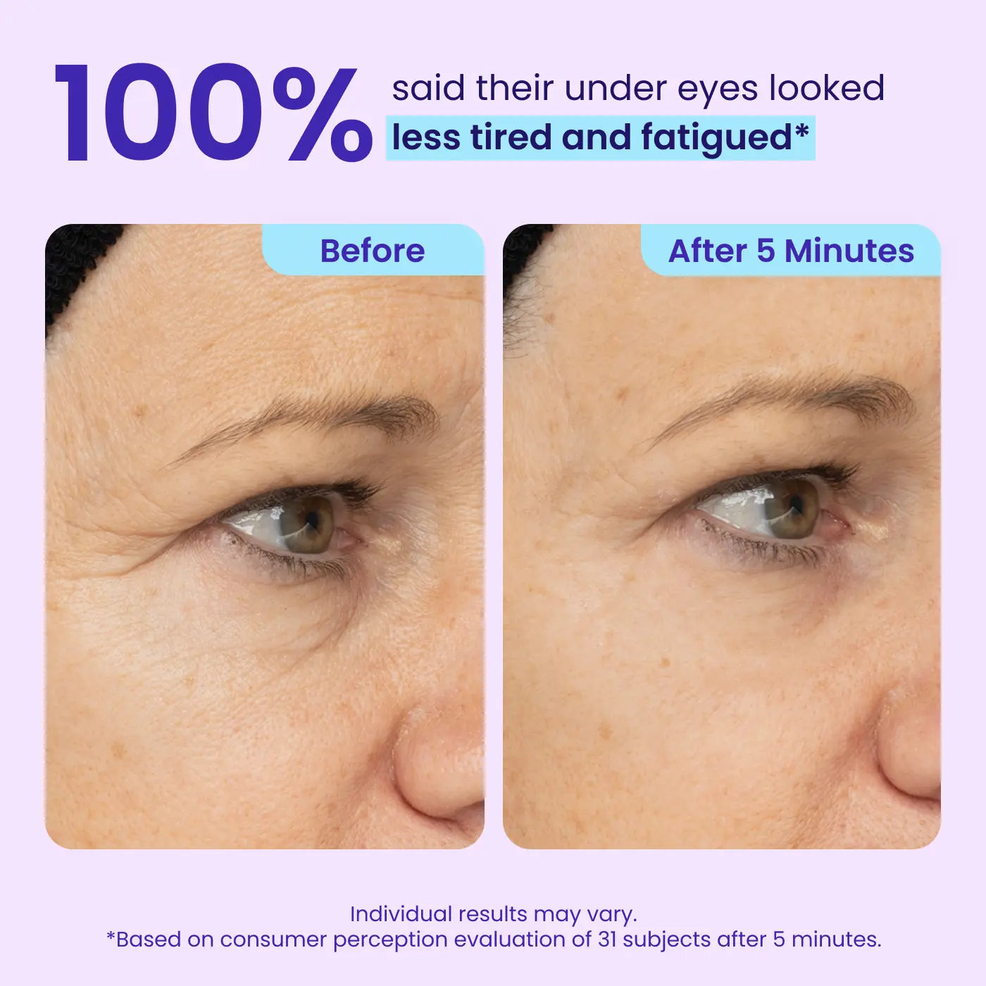 Visibly Tighten & Lift Eye Bags in Just 3 Minutes