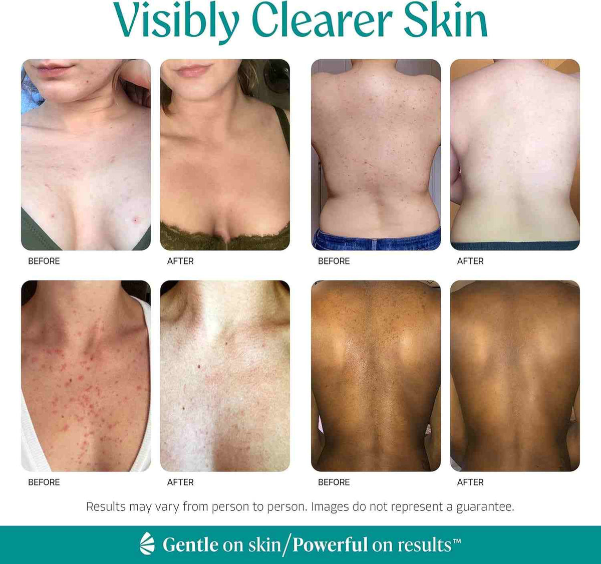 Clear Body Acne & Folliculitis with 15% Mandelic Acid Exfoliating Serum | Buy 1 Get 1 Free