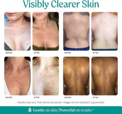 Clear Body Acne & Folliculitis with 15% Mandelic Acid Exfoliating Serum | Buy 1 Get 1 Free