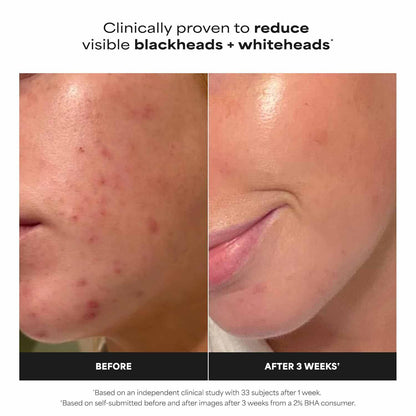 2% BHA Liquid Exfoliator – Unclog Pores & Smooth Skin Texture