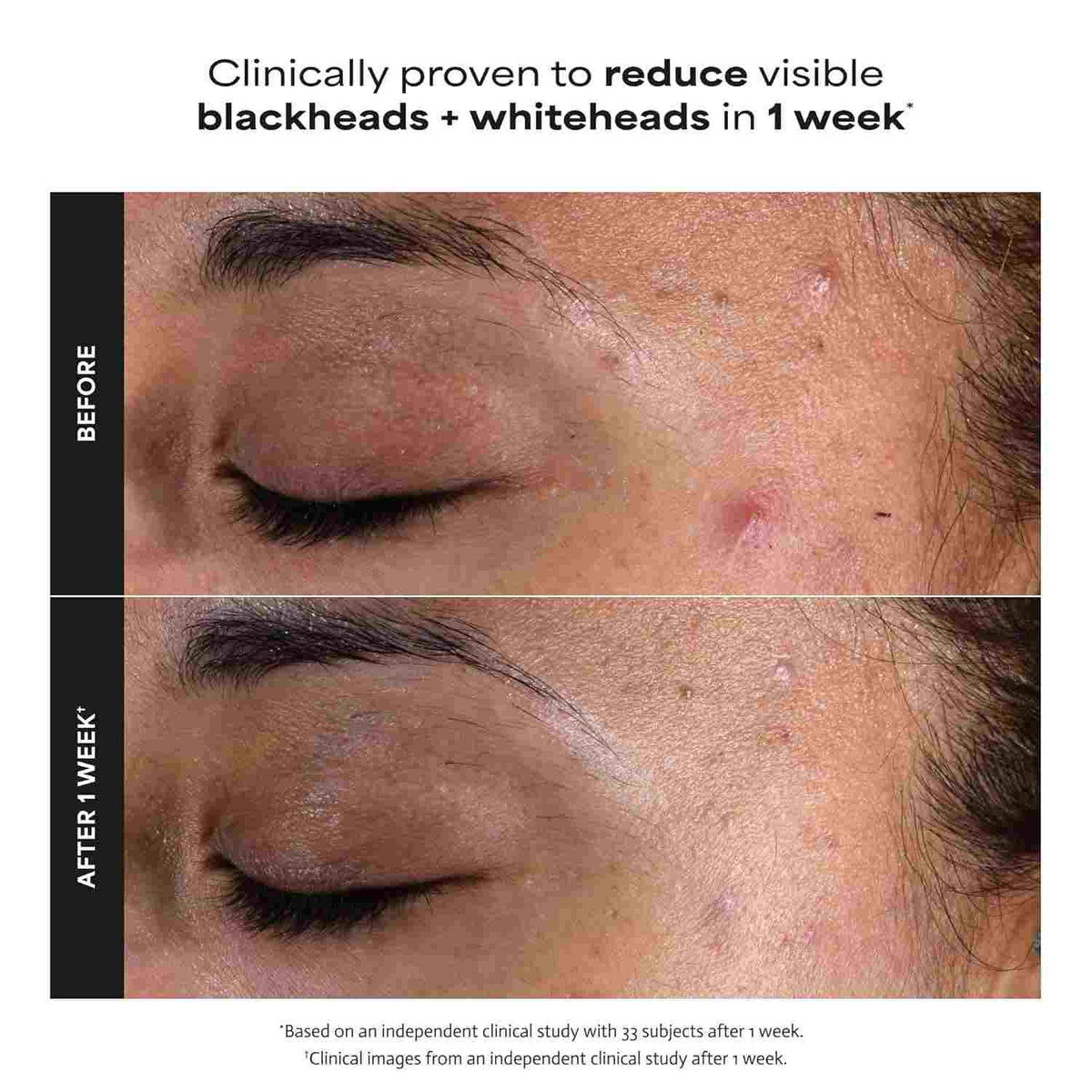 2% BHA Liquid Exfoliator – Unclog Pores & Smooth Skin Texture