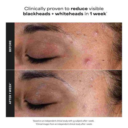 2% BHA Liquid Exfoliator – Unclog Pores & Smooth Skin Texture